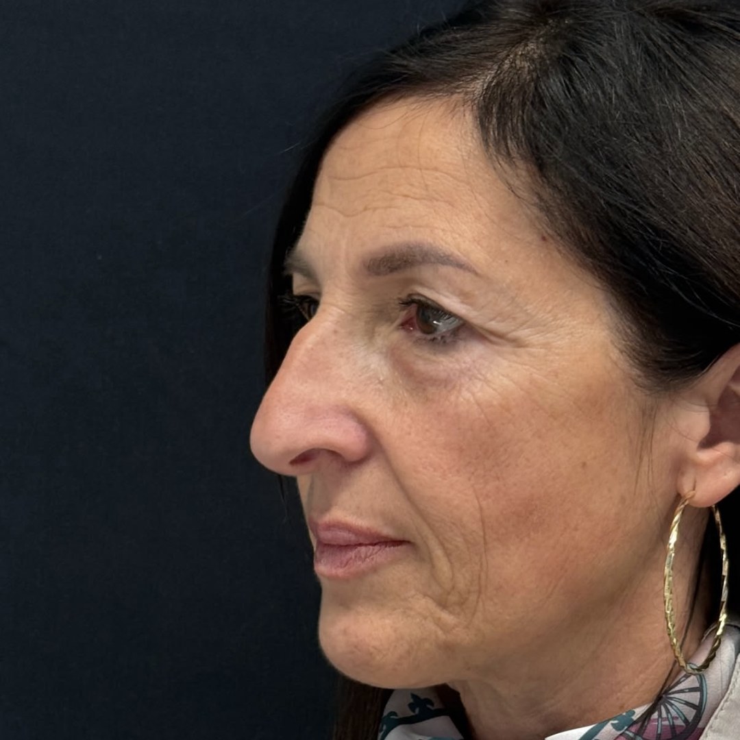 Rinoplastica strutturale: veduta di tre quarti prima dell'intervento